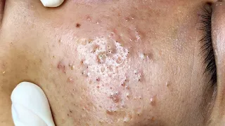 Relaxing Make your Acne Treatment Sac Dep Spa #1019 | Blackheads & Pimple Removal