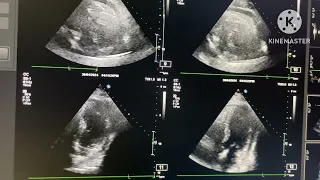 Effusive constrictive pericarditis