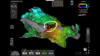 Left Atrial Miccrorrentrant Tacjycardia after previous AF ablation