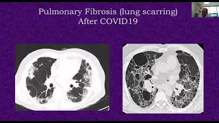 Post-COVID-19 Symptoms and Syndromes