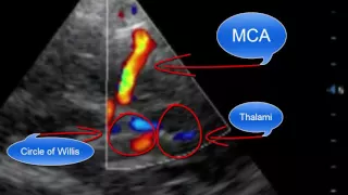 Point-of-care Transcranial Doppler