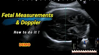 Fetal measurements and Doppler | How to do it !