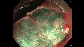 EMR in the right colon