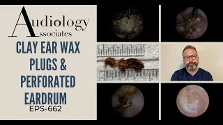 CLAY EAR WAX PLUGS & PERFORATED EARDRUM - EP 662