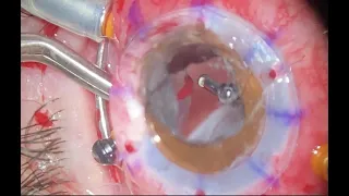 Temporary Keratoprosthesis and Retinal Detachment combined surgery.