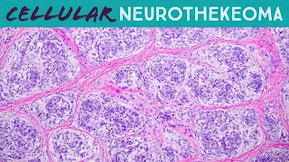 Cellular neurothekeoma (it's NOT a nerve sheath tumor!): Basic soft tissue pathology & dermpath