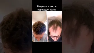 Результаты после пересадки волос | Пересадка волос в Турции #пересадкаволос #пересадкаволосвтурции