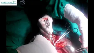 #134 : LOWER SEGMENT CESAREAN SECTION IN A CASE OF BREECH PRESENTATION