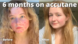My Accutane Journey In Less Than 5 Minutes // month 6