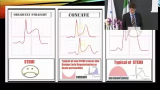 The normal ECGs in athletes: increased QRS voltages, early repolarization. G. Finocchiaro