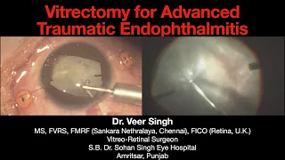 Traumatic Endophthalmitis | Giant Retinal Tear Retinal Detachment | 23 G Vitrectomy | Dr. Veer Singh