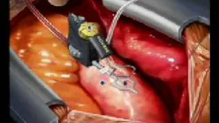 eNclose, assisted proximal anastomosis device in off-pump CABG surgery