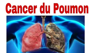 Cancer du poumon  🚬