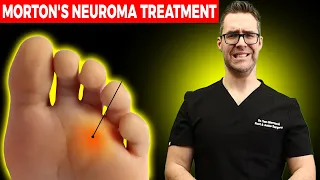 Morton's Neuroma Home Treatment! [NO Surgery For Foot Neuromas!]