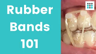 RUBBER BANDS FOR INVISALIGN CLEAR ALIGNERS & BRACES l Dr. Melissa Bailey Orthodontist
