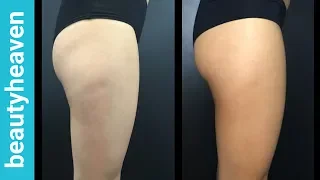 I Tried A Cellulite Treatment And It Actually Worked!