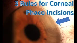 how to make an ideal corneal phaco incision for cataract surgery