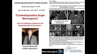 Cerebellopontine Angle Meningioma   I  Sbeih