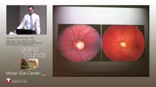 Familial Cavitary Optic Disc Anomaly and Serous Maculopathy