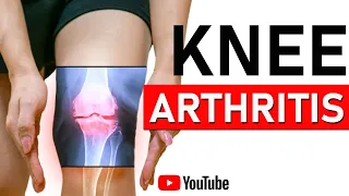 Knee Arthritis (OA). Best Exercises, Treatments & Stretches for Osteoarthritis for Pain Relief
