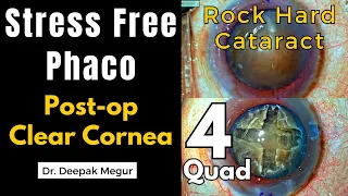 Rock Hard Cataract-The secret to  stress-free Phaco & Clear Cornea -The Classic 4 Quadrant technique