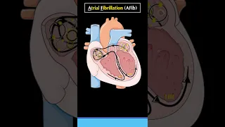 What is Atrial Fibrillation (AF or AFib)  #atrialfibrillation #cardiology #arrhythmia #heart