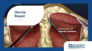 Hernia Repair 3D Animation