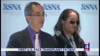 First US Face Transplant Recipient Speaks