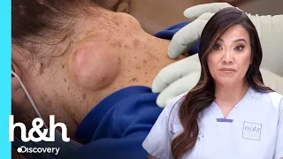Enormes quistes le impiden doblar su cuello | Dra. Sandra Lee: Especialista en piel | Discovery H&H