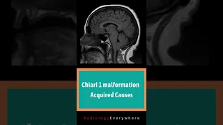 Chiari 1 Malformation Radiology | Acquired Causes | Short video No. 52
