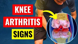 Knee Arthritis - 7 Most Common Signs You Have It!