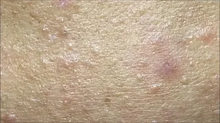 Acne Treament Under The Skin #037