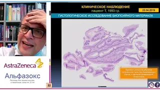 Рак пищевода Баррета у пациента 25 лет: клиническое наблюдение