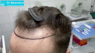 Пересадка волос в Алматы. Клиника Dr.Bezrukova.