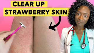 🍓 Strawberry Legs - Why it Happens & How to Get Rid Of It + Products