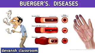 Buerger's diseases ( thromboangitis abliterans)