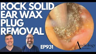 ROCK SOLID EAR WAX PLUG REMOVAL - EP931