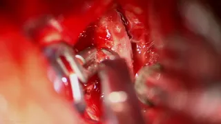 Clipping of a Posterior Communicating Artery Aneurysm Complicated by Intraoperative Rupture