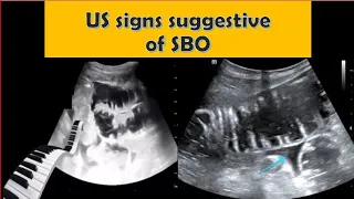 Ultrasound signs suggestive of small bowel obstruction