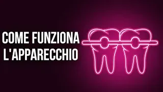 Come Funziona L'Apparecchio Per I Denti