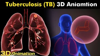 What Happens in Tuberculosis (TB)? | Types, Causes, Symptoms, Treatment | 3D Animation (Urdu/Hindi)