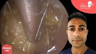 1,157 - Ear Wax Removal in Ear With 2 Eardrums ‘False Fundus’