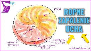 Ostre Ropne Zapalenie Ucha Środkowego — Widok Endoskopowy