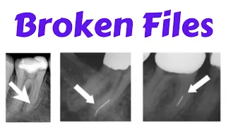 Endodontic Instrument fracture - Separated File, Management of Broken Files- Bypass Technique