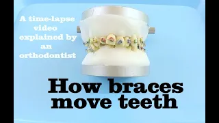 How braces move teeth (time-lapse) - Braces Explained!