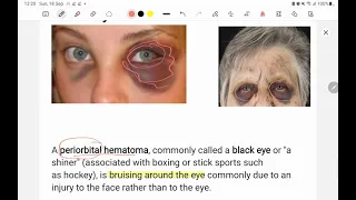 BLACK EYE- Periorbital hematoma ||CLINICAL case discussion🔥