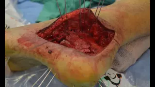 Calcaneal fractures - Operative techniques (OTA lecture series IV L15c)