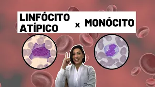 Como diferenciar linfócito atípico do monócito - Biomedicina - Hematologia