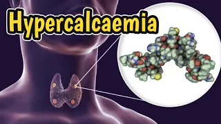 Hypercalcaemia | High Calcium Causes, Symptoms & Diagnosis | Electrolyte Imbalance |