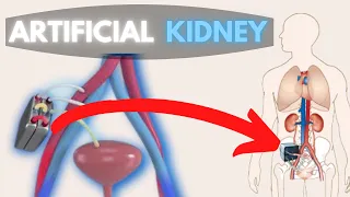 Artificial Kidney Successfully tested, Breakthrough for Kidney Disease, How Dialysis works